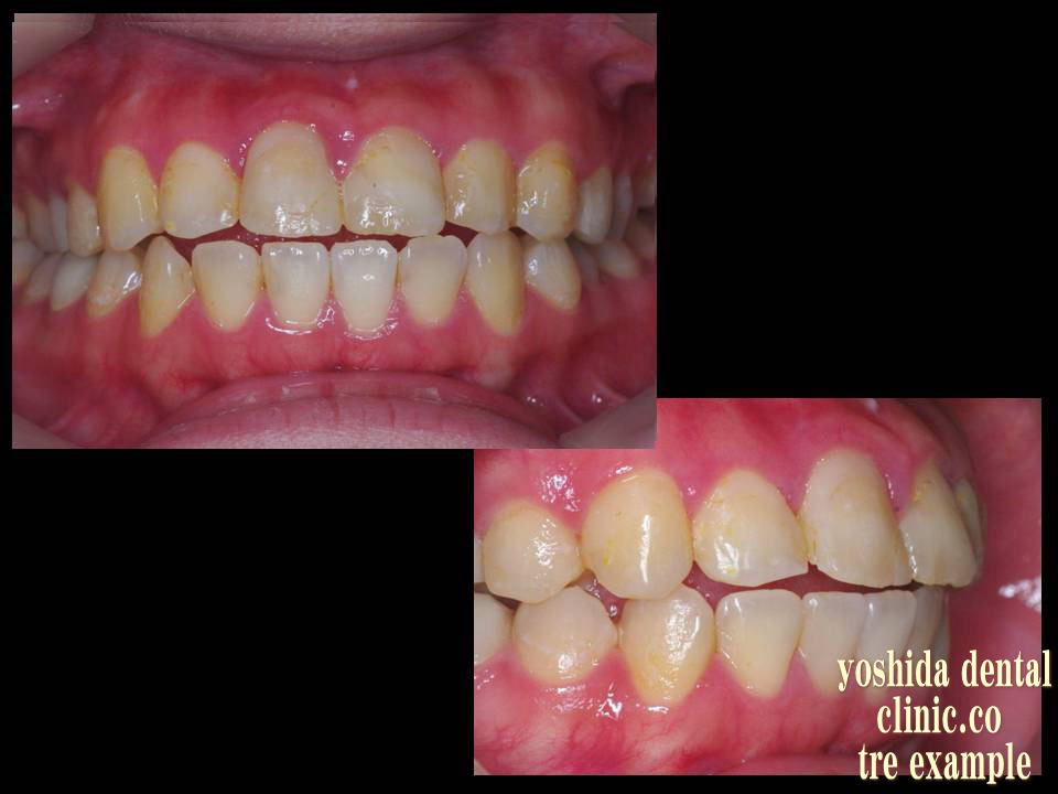 CADCAM冠前歯治療前