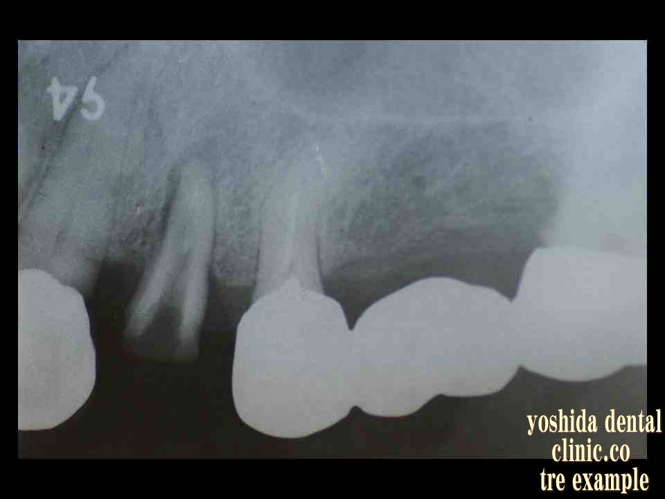 歯周組織改善レントゲン