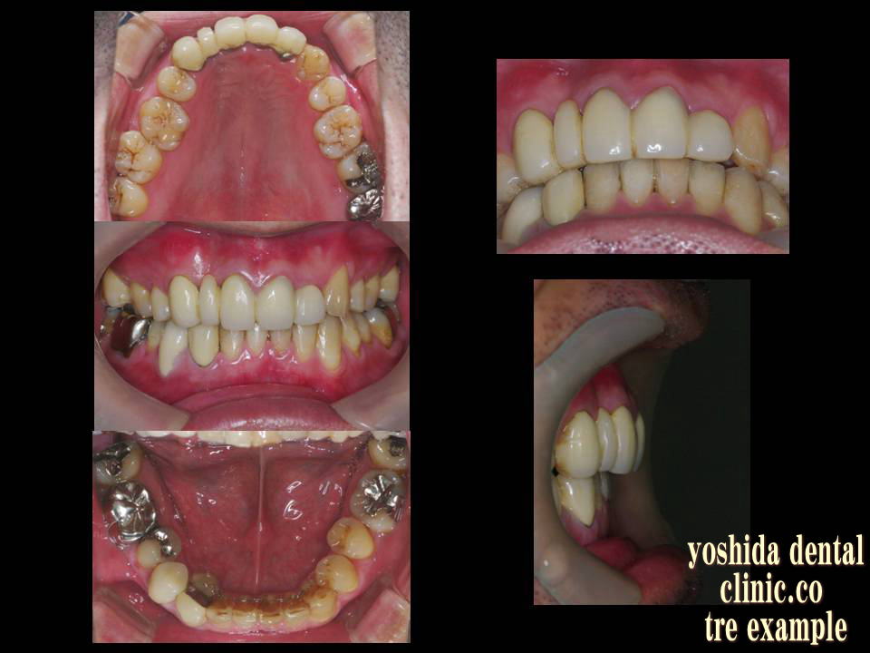下顎前歯矯正および上顎補綴治療