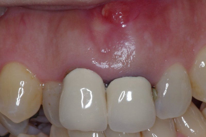 慢性化膿性根尖性歯周炎