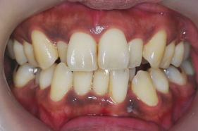 前歯歯列不正