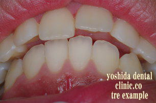 前歯歯列不正