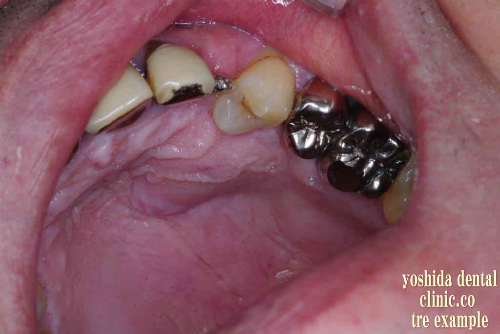 歯牙腫瘍摘出前