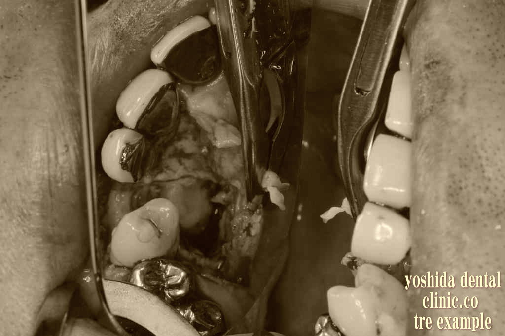 歯牙腫瘍摘出中