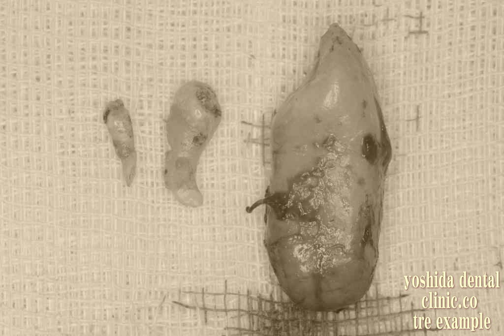 歯牙腫瘍摘出後