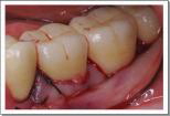 歯肉の移植
