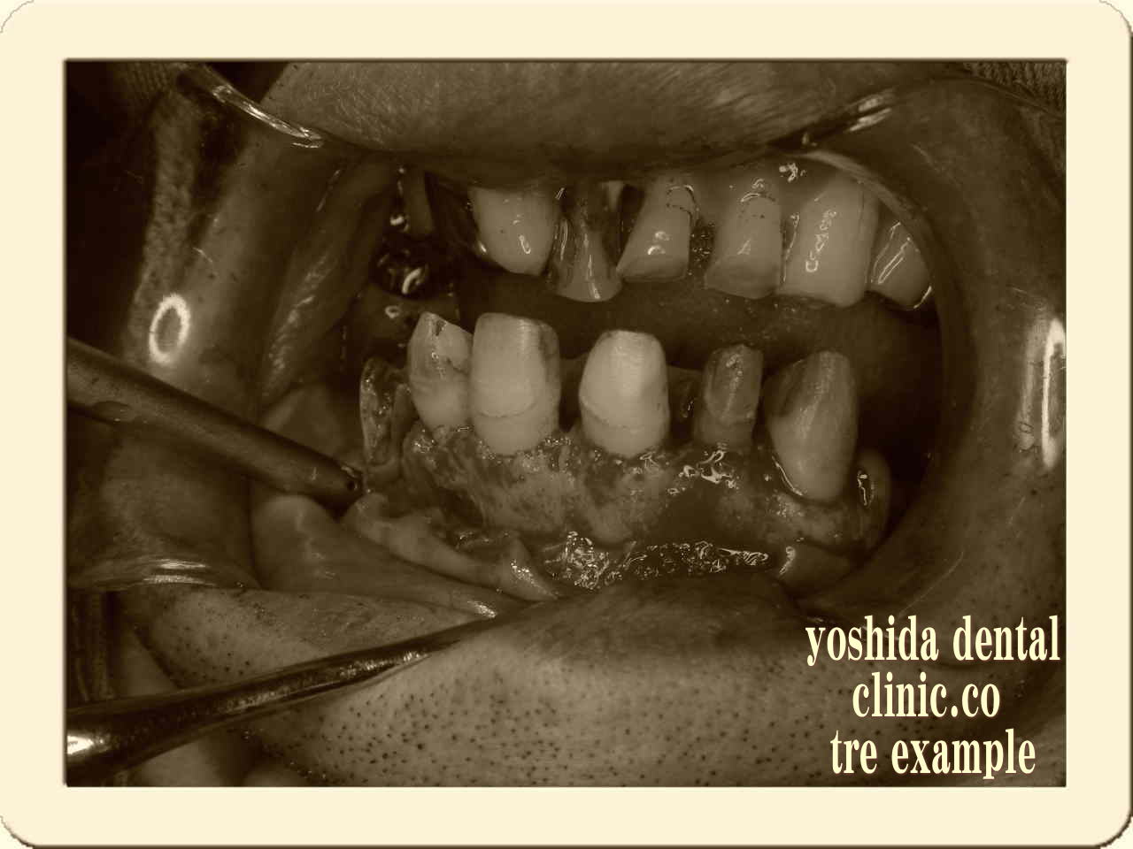 歯周外科中