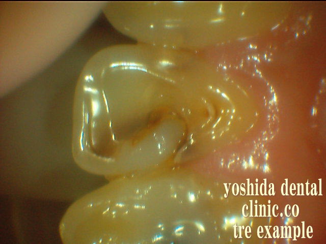 前歯修復物不適合舌側面観