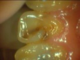 前歯修復物不適合舌側面観
