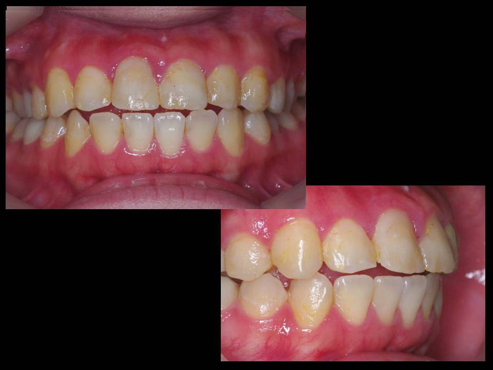 CADCAM冠前歯治療前