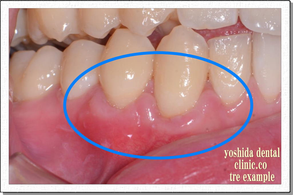 歯冠側への歯肉移動