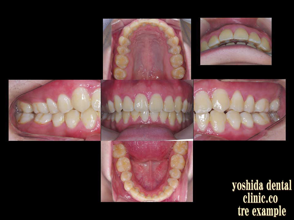 上顎前突成人矯正治療後