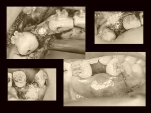 骨造成と歯周造成ジルコニアインプラント