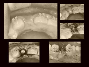 2次手術と歯周造成