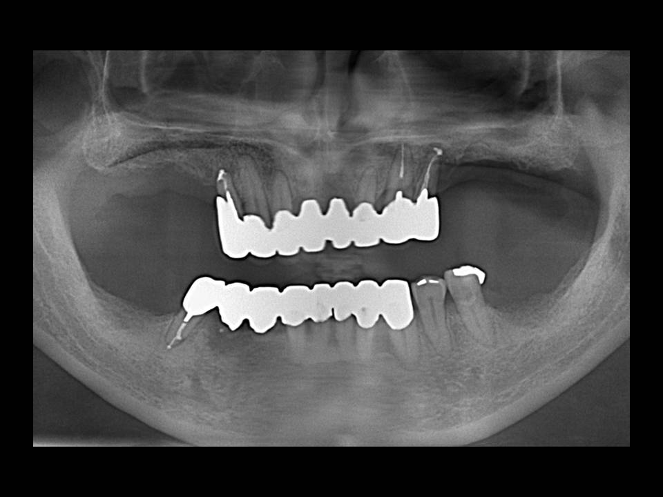 現存歯の保存治療後Xray