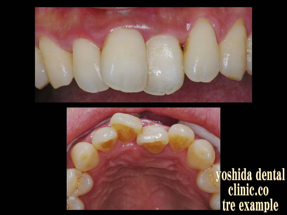 歯周病による歯列不正