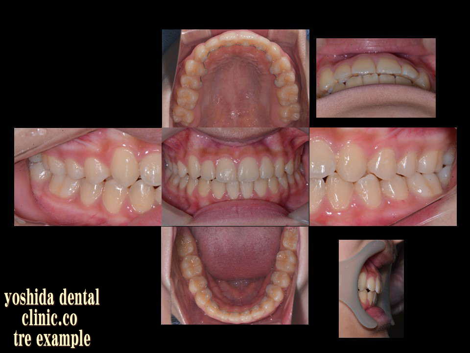 上顎叢生矯正治療後