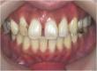 半顎矯正と前歯補綴処置