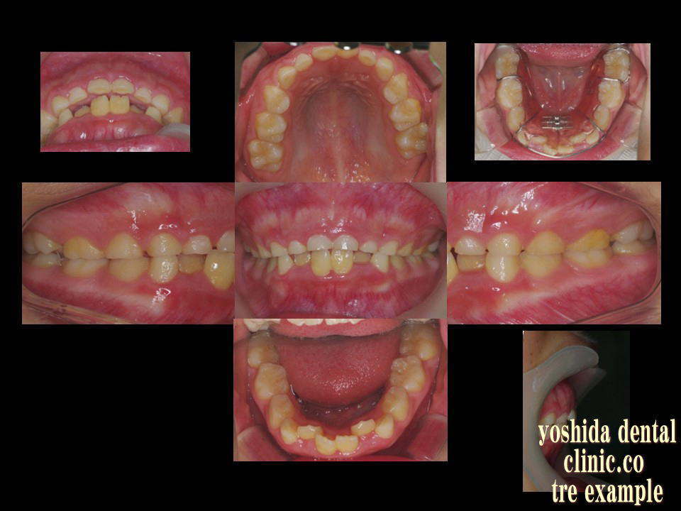 矯正治療Ⅰ期治療