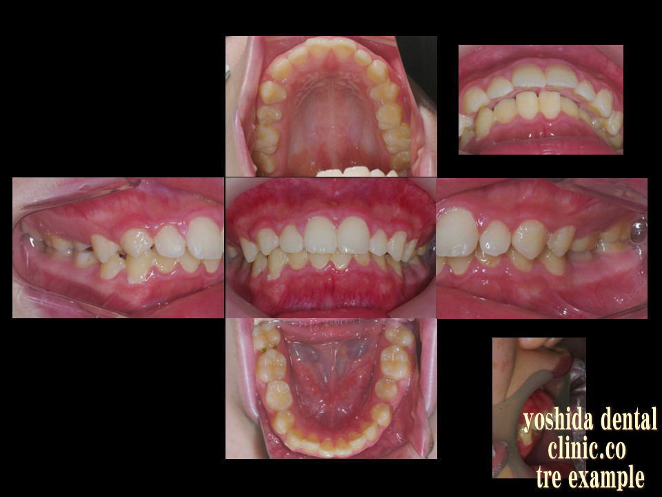 矯正治療Ⅱ期治療前