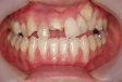 半顎矯正と前歯補綴処置