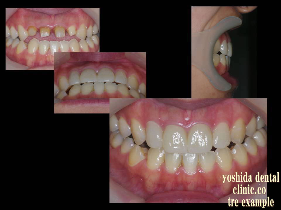 部分矯正ジルコニア後