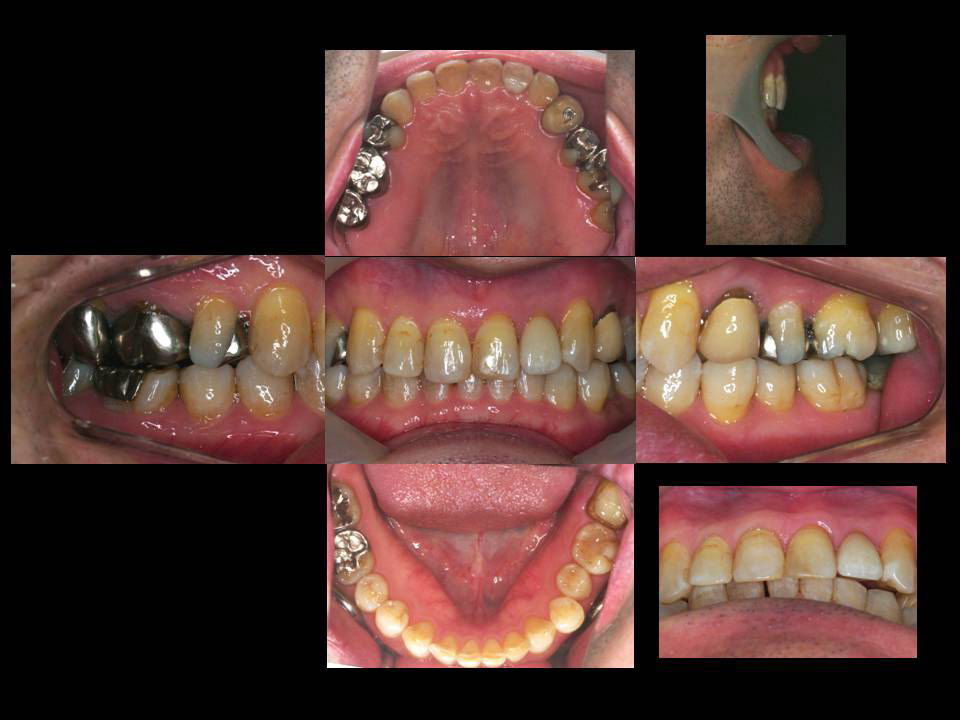 咬合の強さによる歯牙異常