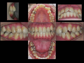 歯列不正と歯の形態異常