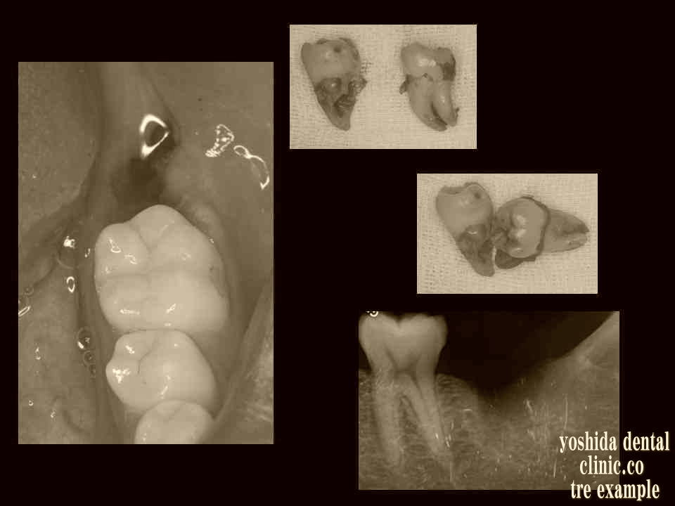 歯牙移植レシピエントサイトの抜歯