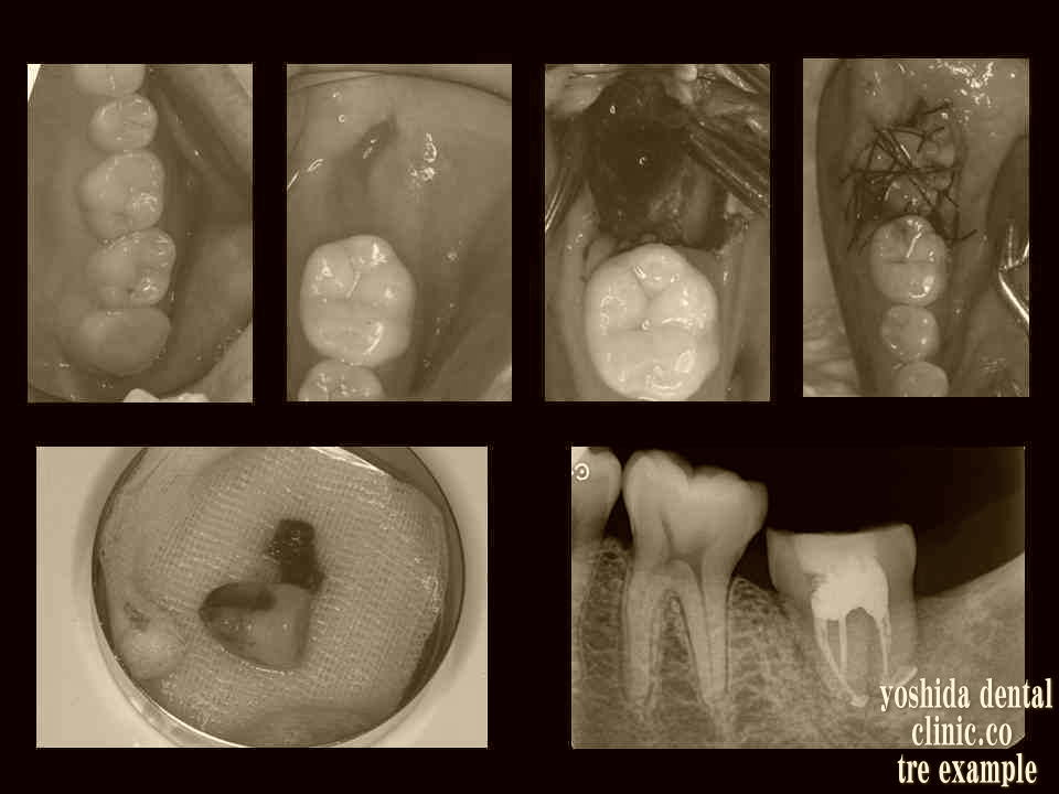 歯牙移植術ドナーサイトからレシピエントサイトへ