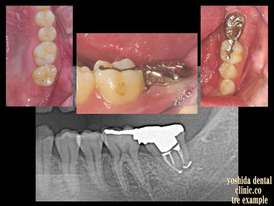 歯牙移植歯生着後の補綴