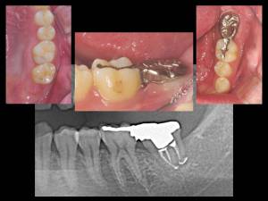 歯牙移植歯生着後の補綴